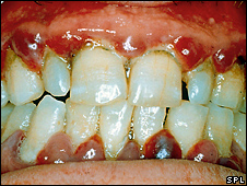 Bad gums are linked to health problems