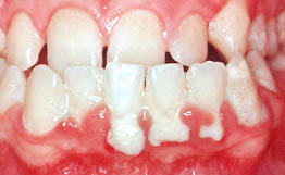 Advanced Periodontal Disease