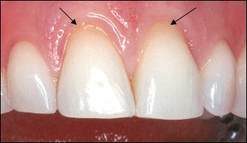 Exposed Roots on Central Incisors