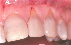 Recession on the lateral and cuspid tooth