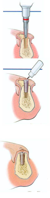 How a dental implant is placed