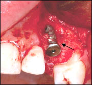 Implant Defect
