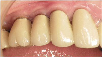 Implant supported Teeth