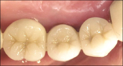 Implant supported teeth biting surfaces